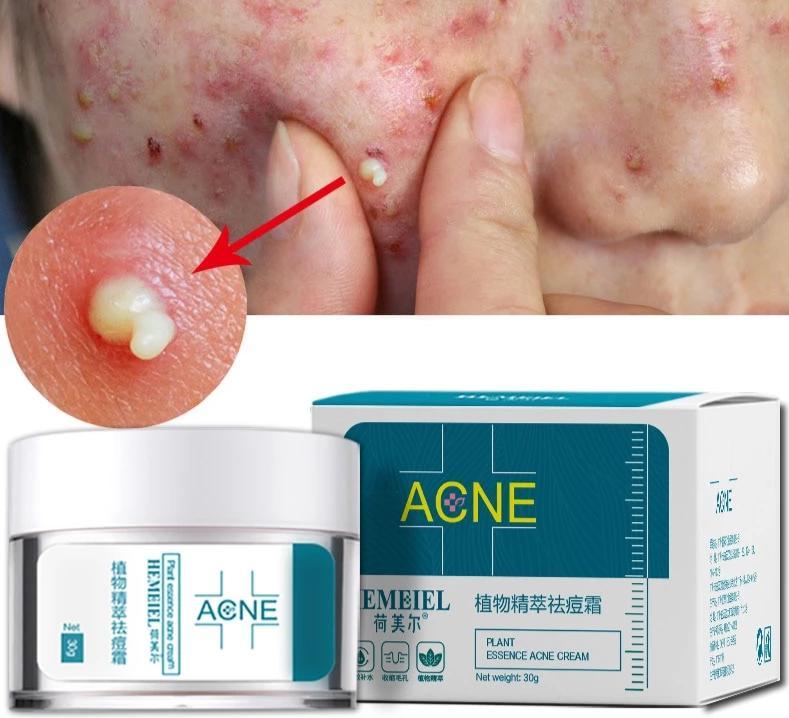 Creme para acne
