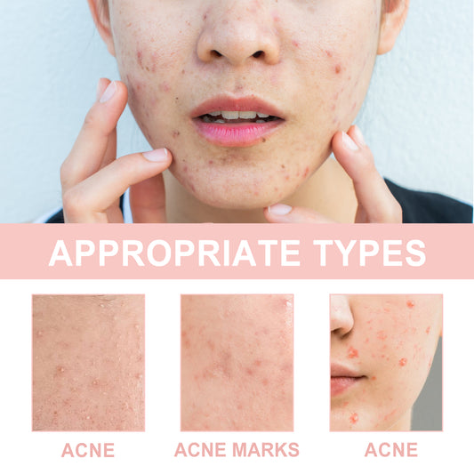 OUHOE Adesivo para Acne Reparo de Acne Acne Vermelhidão Limpeza de Poros e Hidratação