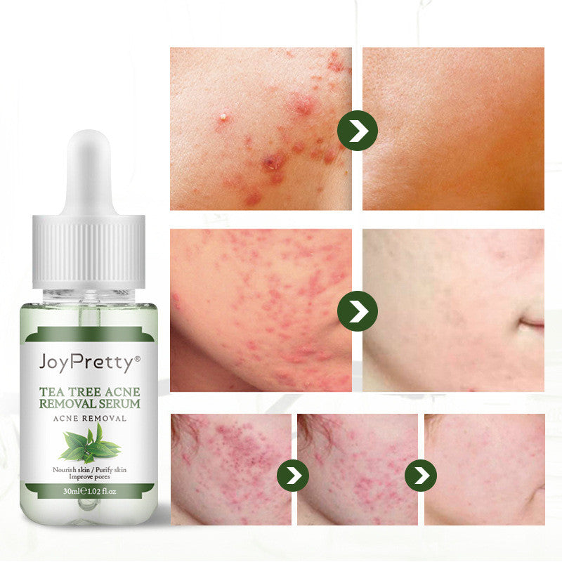 Sbiadire i segni dell'acne e la cura della pelle all'albero del tè contro l'acne