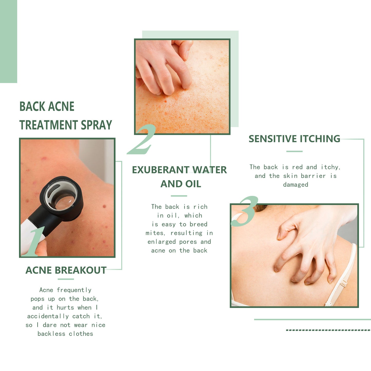 Spray riparatore per acne sulla schiena, sulle spalle, dissalazione dell'acne, segni dell'acne, cura della pelle