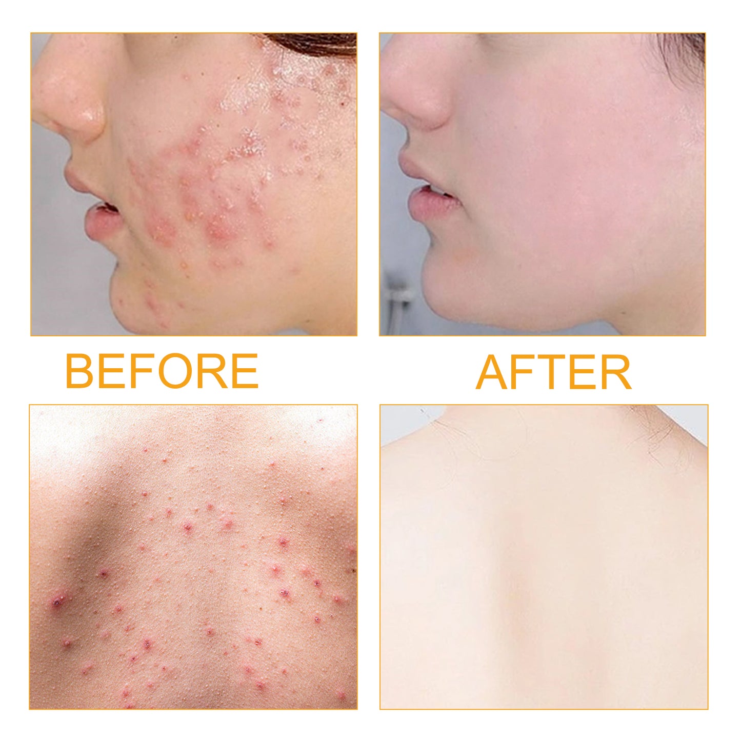 Jayusing Siero Anti-Acne e Anti-Macchie, Riduce Acne e Segni di Acne, Siero Idratante Riparatore per la Pelle