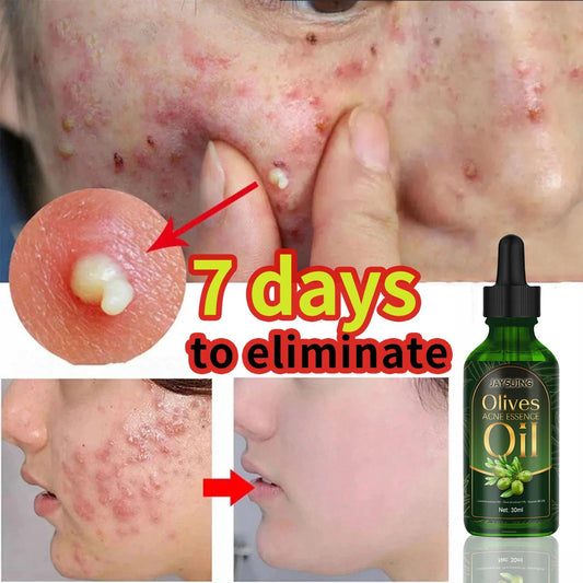 Óleo Essencial Removedor de Oleosidade Facial para Acne, Hidratante Suave, Reparação de Cicatrizes de Acne, Clareador de Marcas de Espinhas