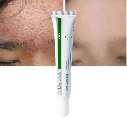 Gel Reparador Nutritivo e Suave para Acne