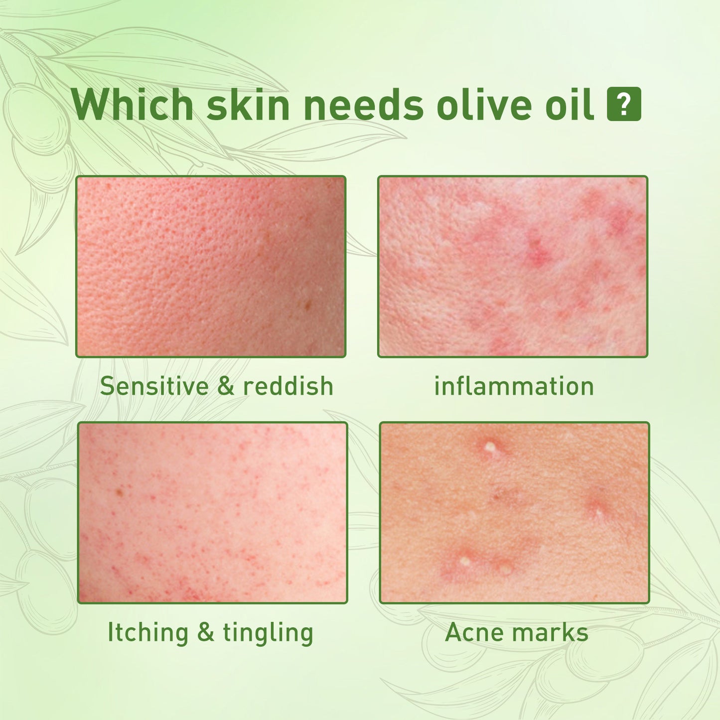 Rimuovi l'olio per il viso, idratante delicato per l'acne, liquido riparatore per i segni dell'acne, olio essenziale per eliminare i segni dell'acne.