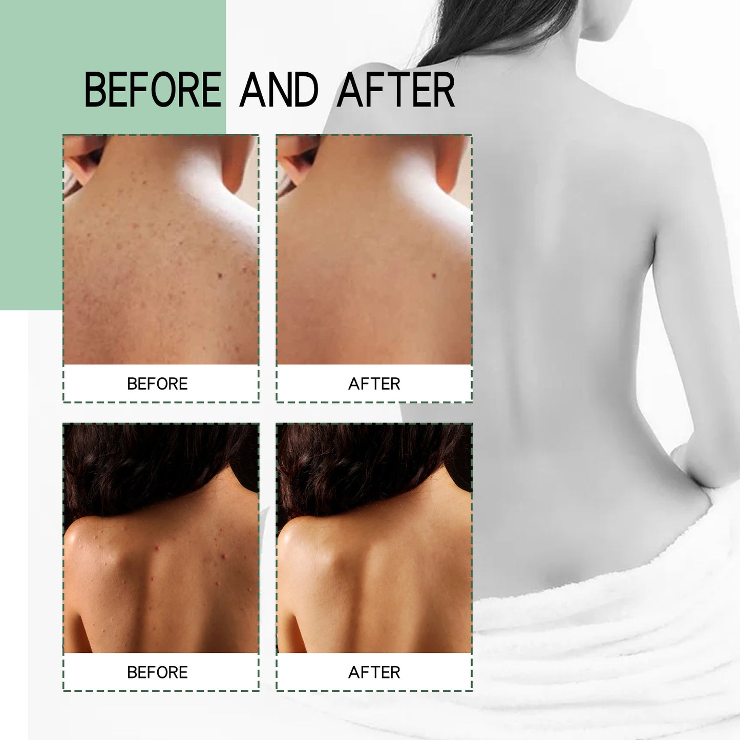 Spray riparatore per acne sulla schiena, sulle spalle, dissalazione dell'acne, segni dell'acne, cura della pelle