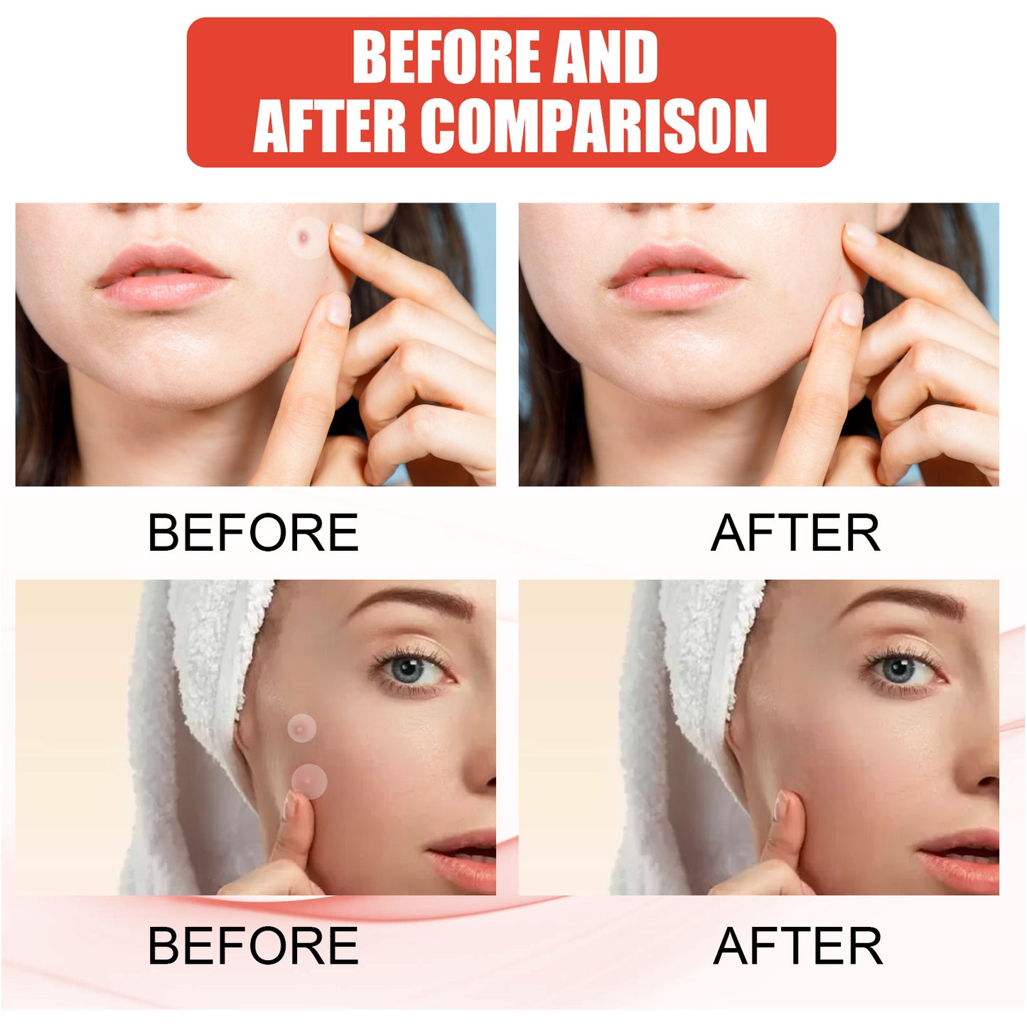 Cerotto per acne idrocolloidale Cerotto per acne chiusa da trucco
